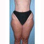 Liposuction 10 Before Photo - 6