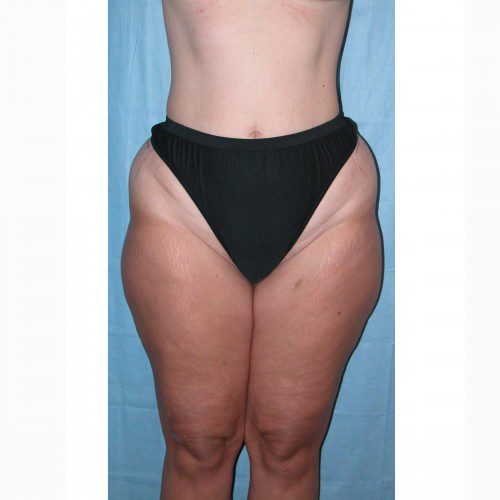 Liposuction 10 Before Photo 