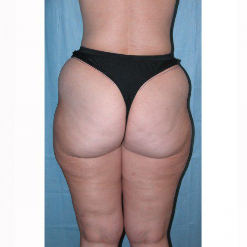 Liposuction 10 Before Photo