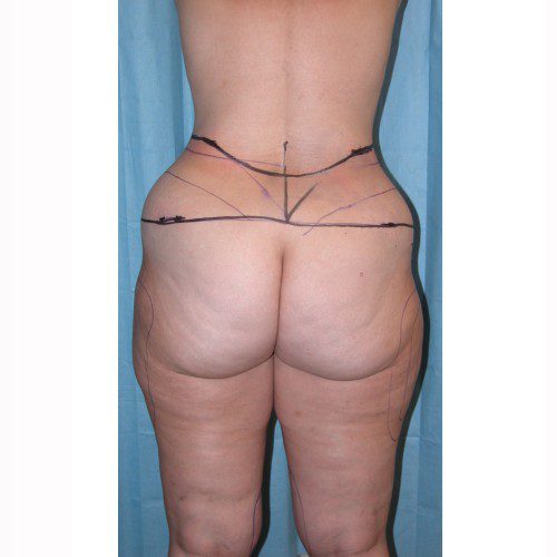 Liposuction 10 After Photo