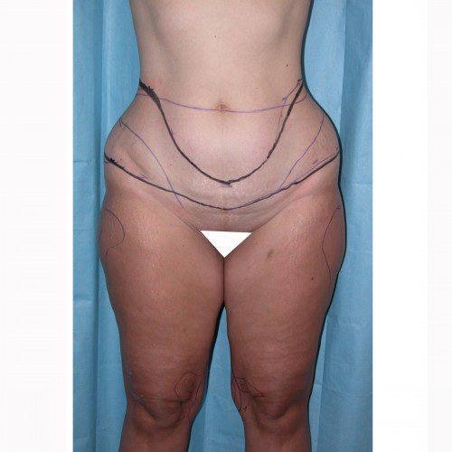 Liposuction 10 Before Photo