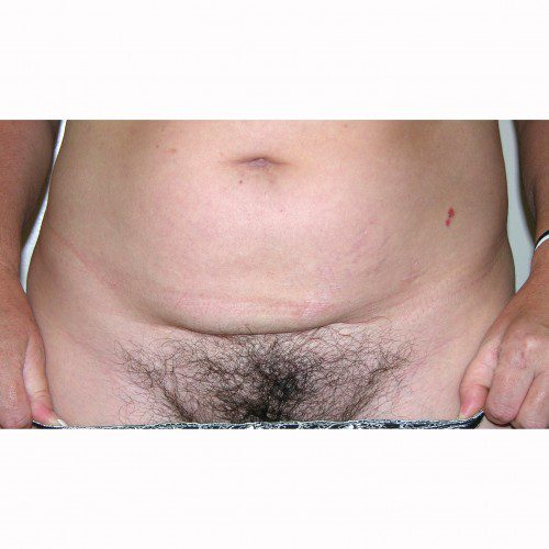 Liposuction 11 Before Photo 