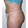 Liposuction 11 Before Photo Thumbnail