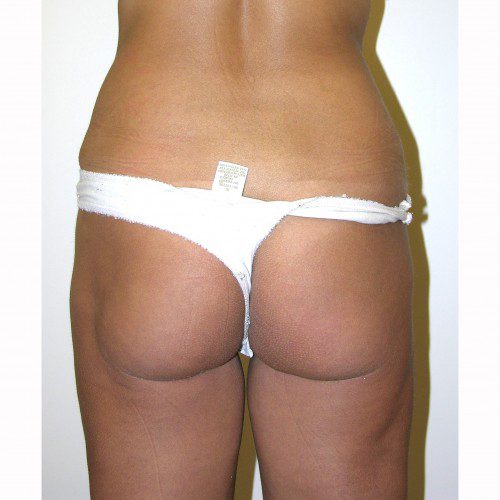 Liposuction 15 After Photo 