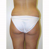 Liposuction 15