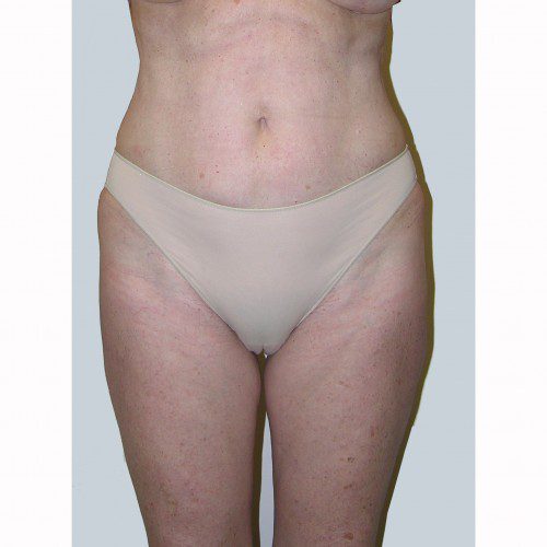 Liposuction 16 After Photo 