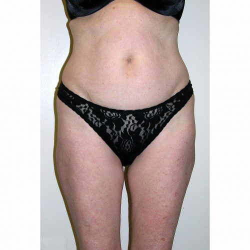 Liposuction 16 Before Photo 