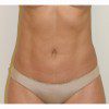 Liposuction 17 After Photo Thumbnail