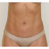 Liposuction 17