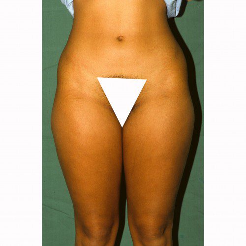 Liposuction 9 Before Photo 