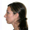 Rhinoplasty 1 After Photo Thumbnail