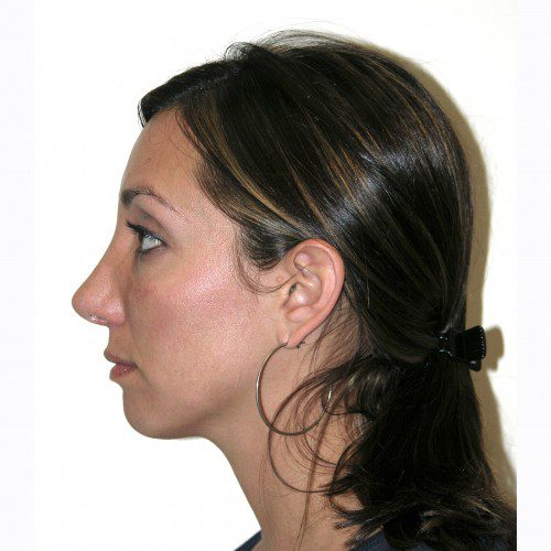 Rhinoplasty 1 After Photo