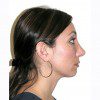 Rhinoplasty 1 After Photo Thumbnail