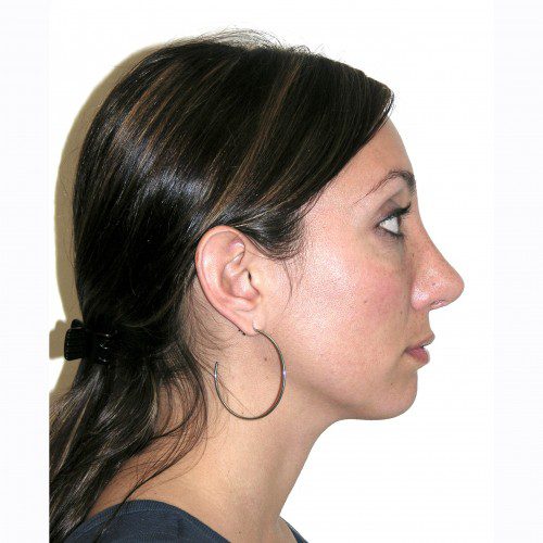 Rhinoplasty 1 After Photo