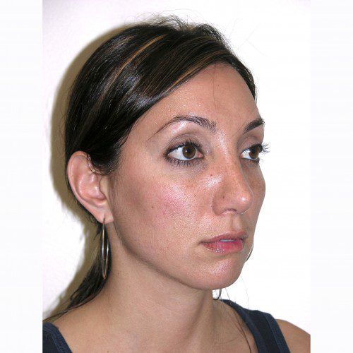 Rhinoplasty 1 After Photo