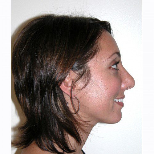 Rhinoplasty 1 Before Photo