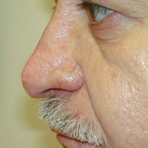 Rhinoplasty 3 After Photo