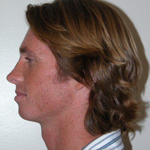 Rhinoplasty 4 After Photo