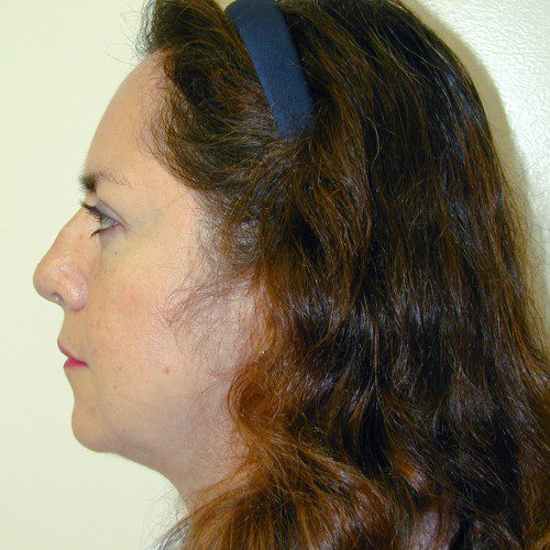 Rhinoplasty 5 Before Photo