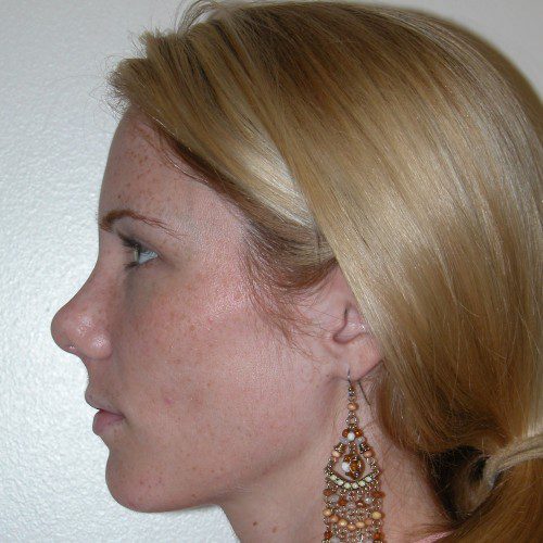 Rhinoplasty 6 After Photo