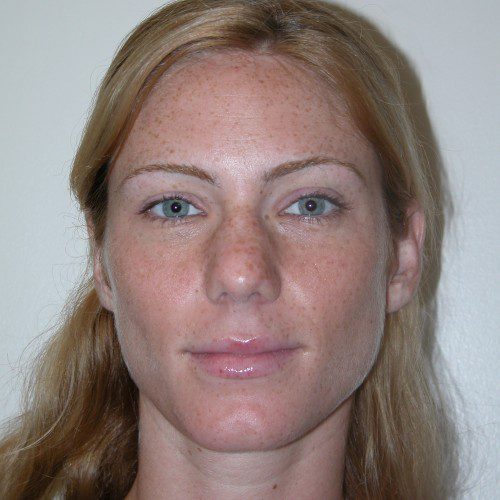 Rhinoplasty 6 Before Photo 