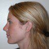 Rhinoplasty 6 Before Photo Thumbnail