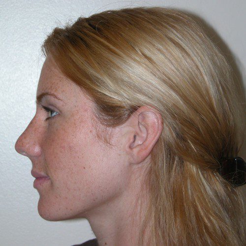 Rhinoplasty 6 Before Photo