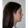 Rhinoplasty 7 Before Photo Thumbnail