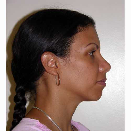 Rhinoplasty 8 After Photo