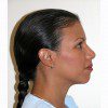 Rhinoplasty 8 Before Photo Thumbnail