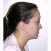 Rhinoplasty 10 After Photo Thumbnail