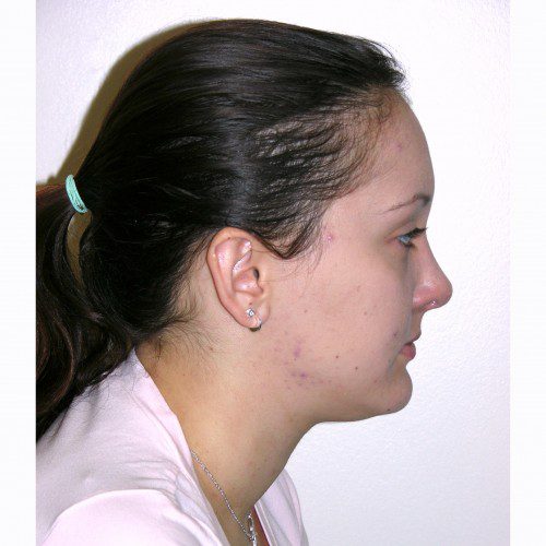 Rhinoplasty 10 After Photo