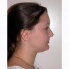 Rhinoplasty 10 Before Photo Thumbnail