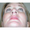 Rhinoplasty 12 After Photo Thumbnail