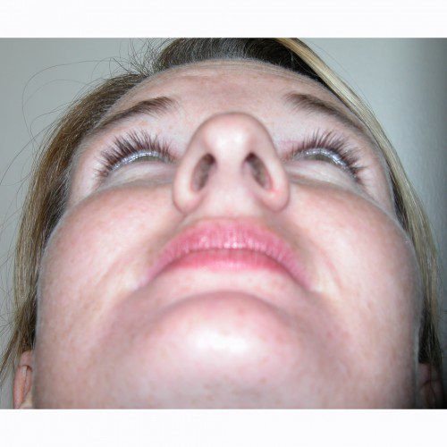 Rhinoplasty 12 Before Photo