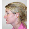 Rhinoplasty 12 Before Photo Thumbnail