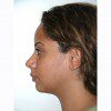 Rhinoplasty 13 After Photo Thumbnail