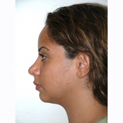 Rhinoplasty 13 After Photo