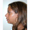 Rhinoplasty 13 Before Photo Thumbnail