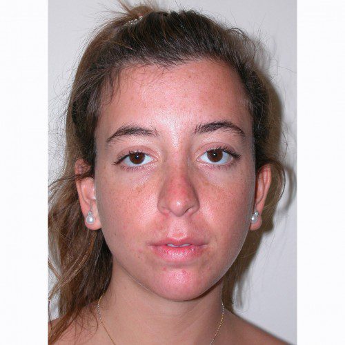 Rhinoplasty 14 After Photo 