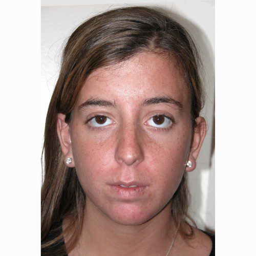 Rhinoplasty 14 Before Photo 