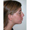 Rhinoplasty 14 Before Photo Thumbnail