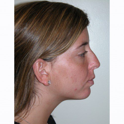 Rhinoplasty 14 Before Photo