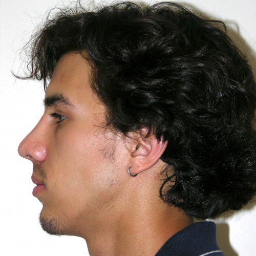 Rhinoplasty 16 After Photo