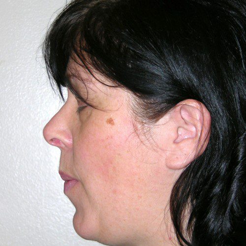 Rhinoplasty 17 After Photo