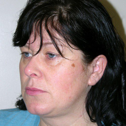 Rhinoplasty 17 After Photo