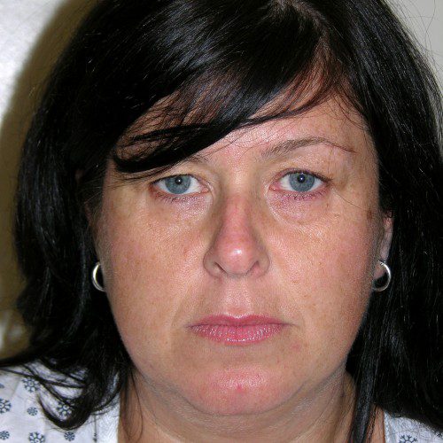 Rhinoplasty 17 Before Photo 