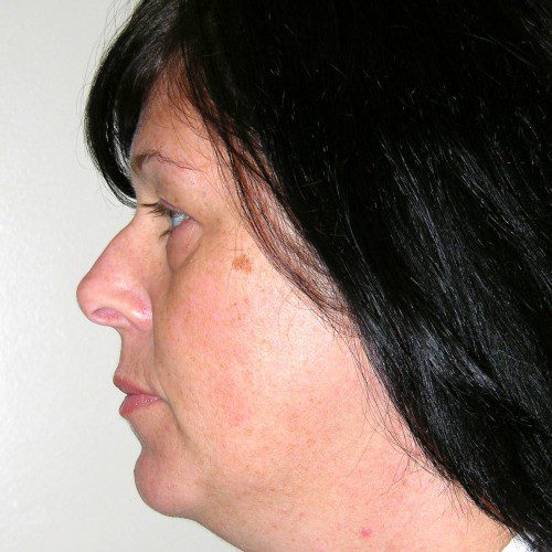 Rhinoplasty 17 Before Photo