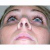 Rhinoplasty 9 After Photo Thumbnail