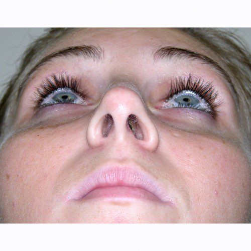 Rhinoplasty 9 After Photo